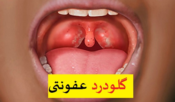 عکس گلودرد عفونتی 