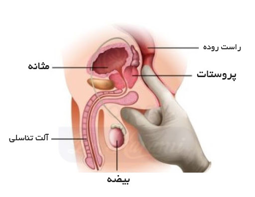 عکس پروستات