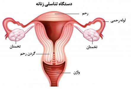 سرطان تخمدان در زنان