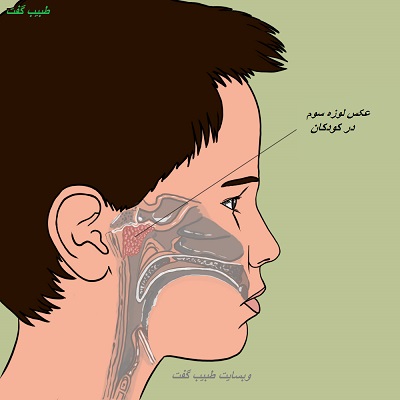 عکس لوزه سوم در کودکان