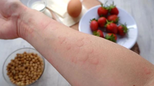 میوه های حساسیت زا برای کهیر
