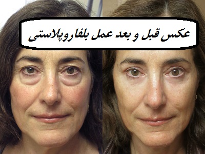 عکس قبل و بعد عمل بلفاروپلاستی
