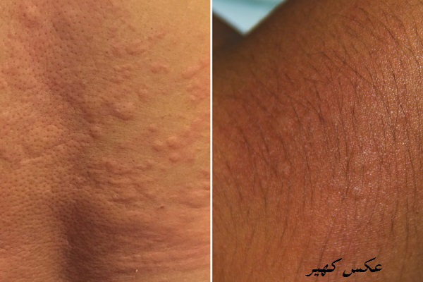 عکس کهیر پوست