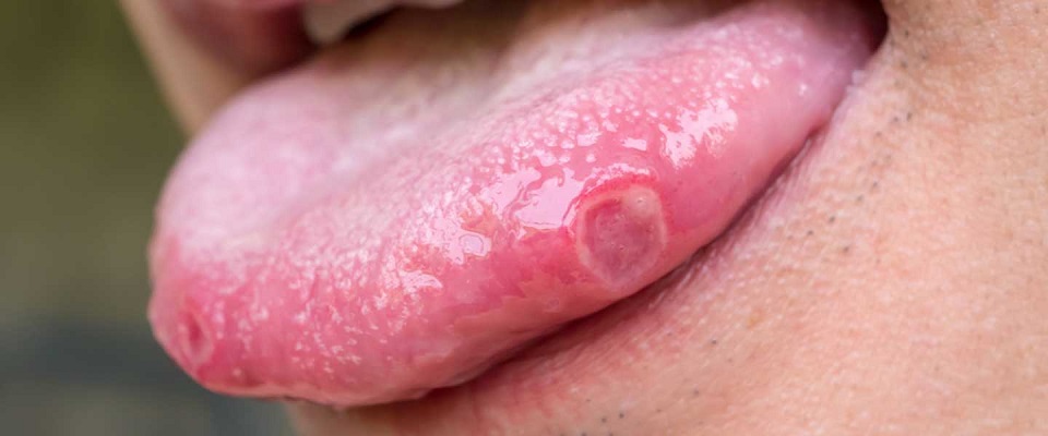 زخم روی زبان علت چیست