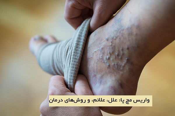 واریس مچ پا: علل، علائم، و روش‌های درمان (راهنمای جامع)
