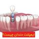 ایمپلنت دندان چیست؟ بهترین روش جایگزینی دندان‌های از دست رفته