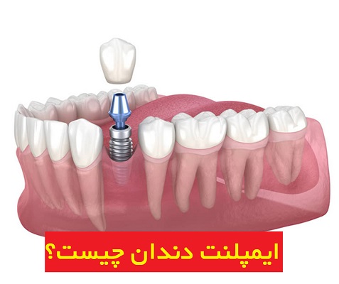 ایمپلنت دندان چیست؟ بهترین روش جایگزینی دندان‌های از دست رفته