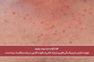 علت دانه های قرمز روی پوست همراه با خارش فولیکولیت