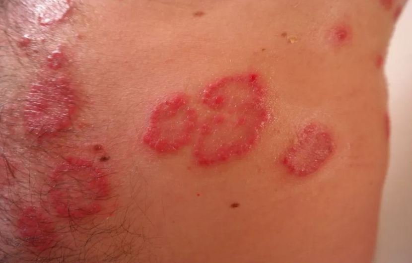 علت دانه های قرمز روی پوست همراه با خارش-پیتریازیس روزه‌آ (Pityriasis Rosea)
