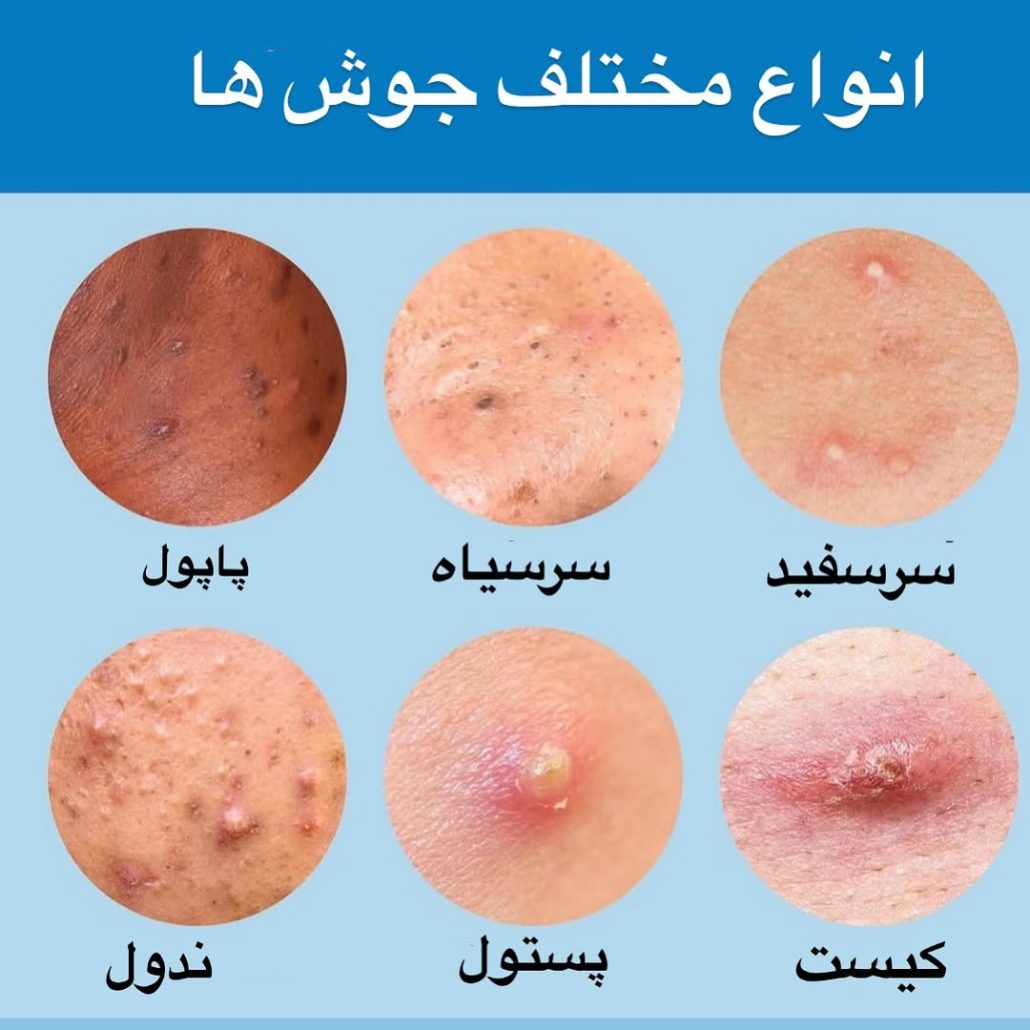 انواع جوش
