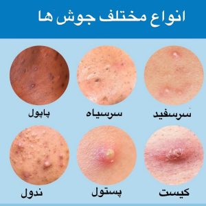 انواع مختلف جوش ها روی صورت و بدن + عکس و توضیحات