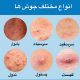 انواع مختلف جوش ها روی صورت و بدن + عکس و توضیحات